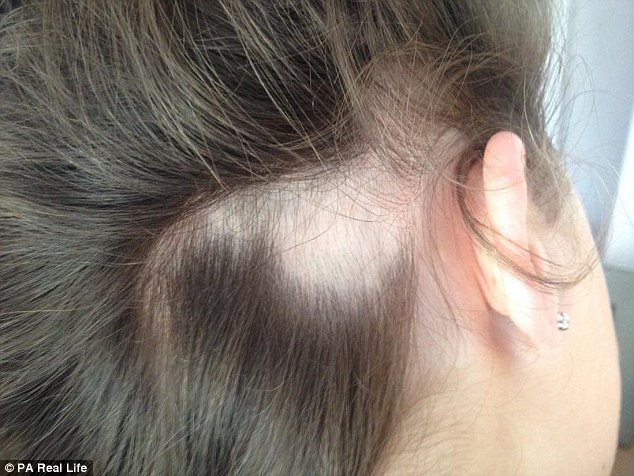 Alopecia Areata Treatment