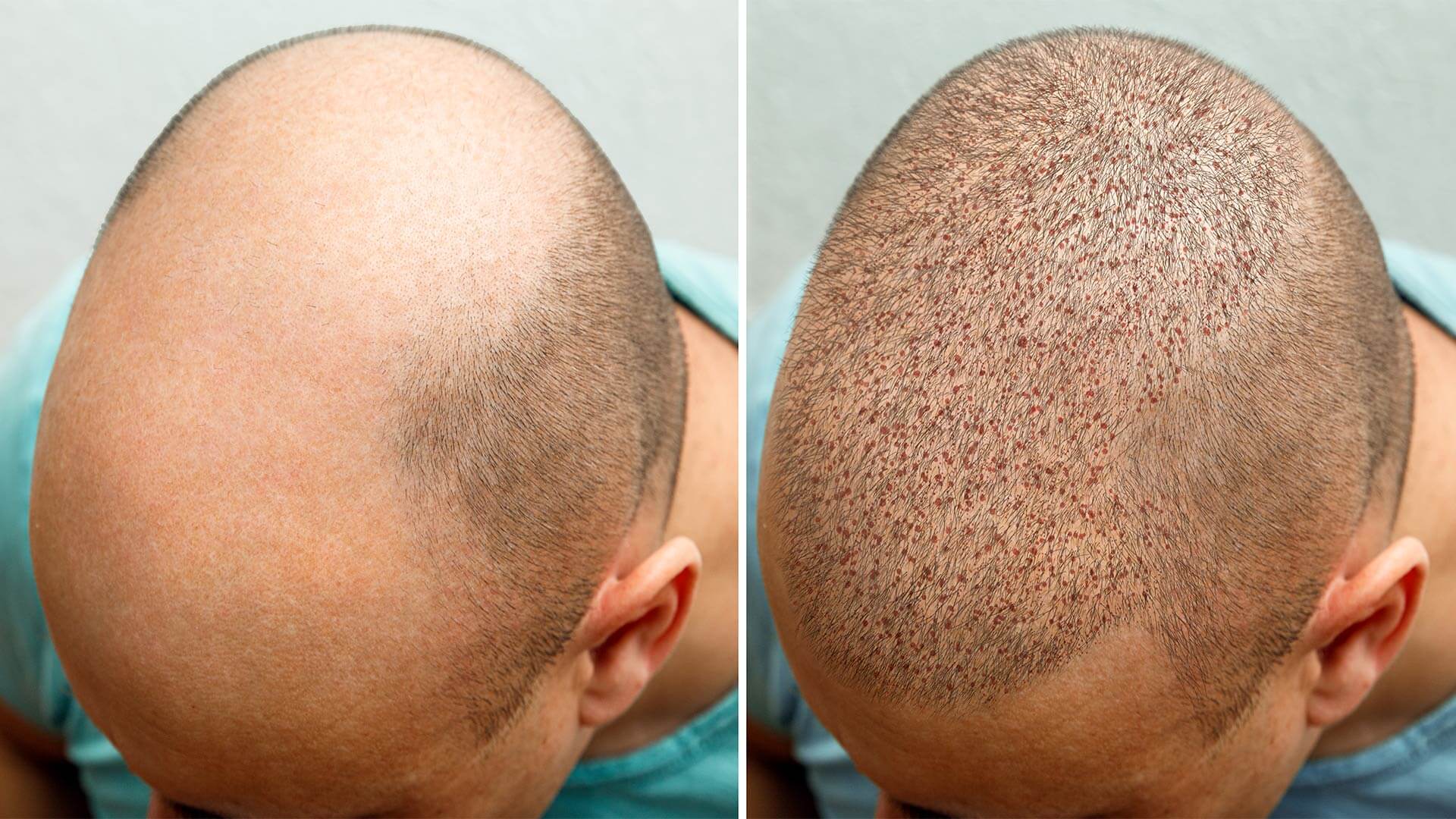 Best Hair Transplant in Delhi