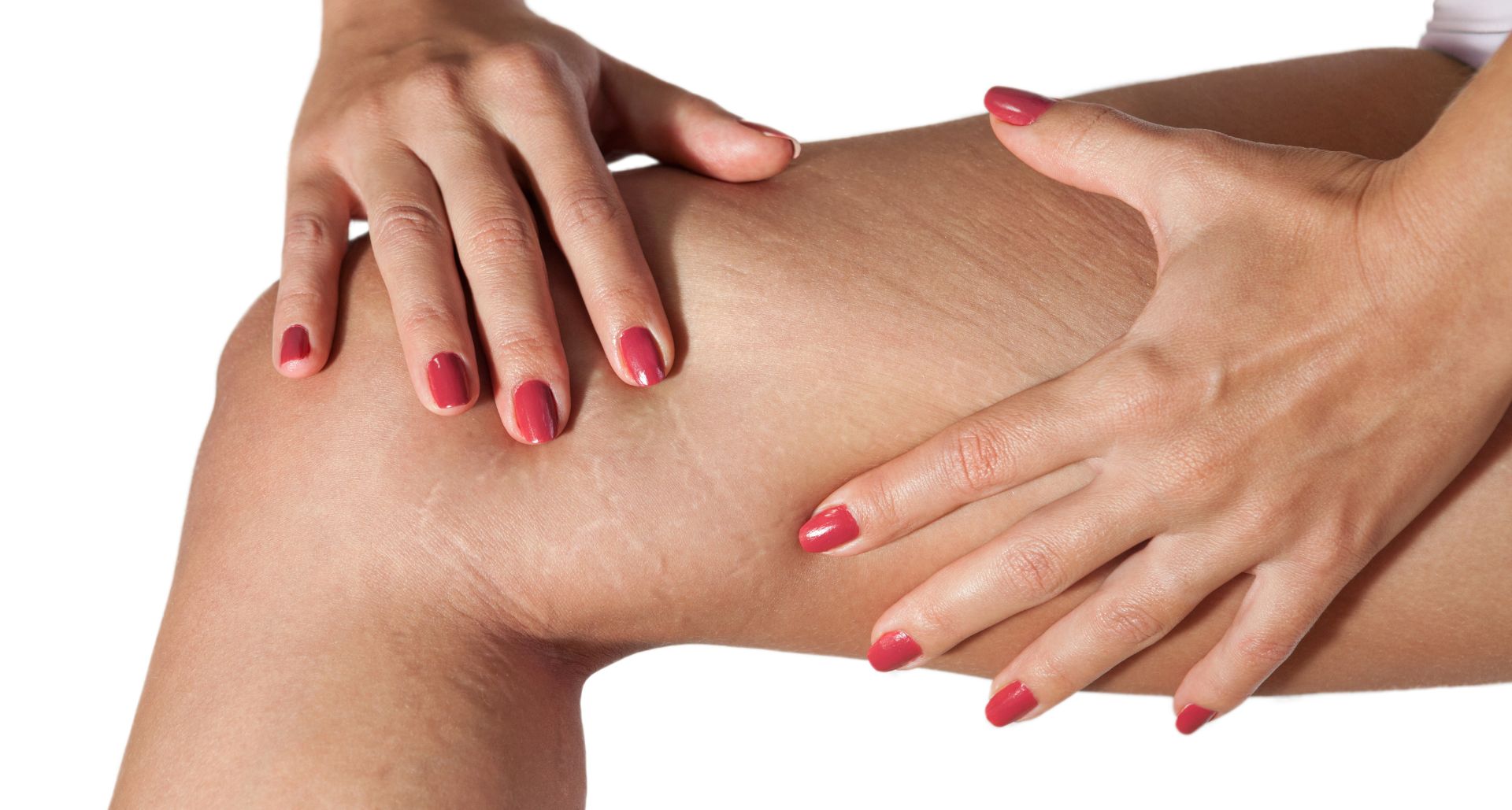 stretch marks removal